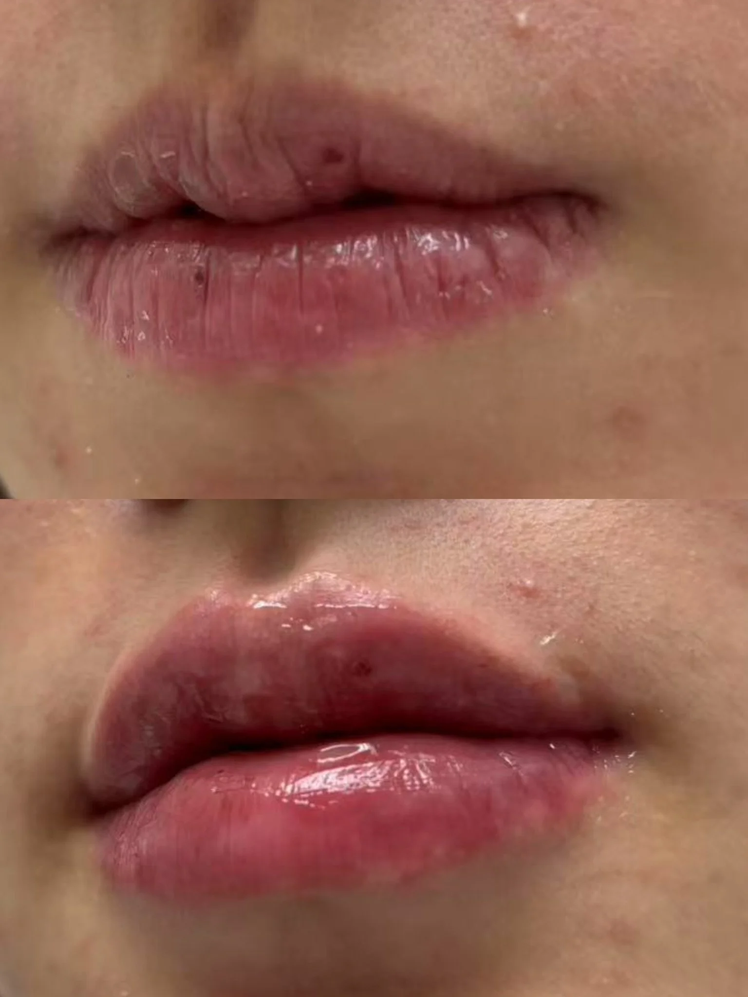 Lip Filler
