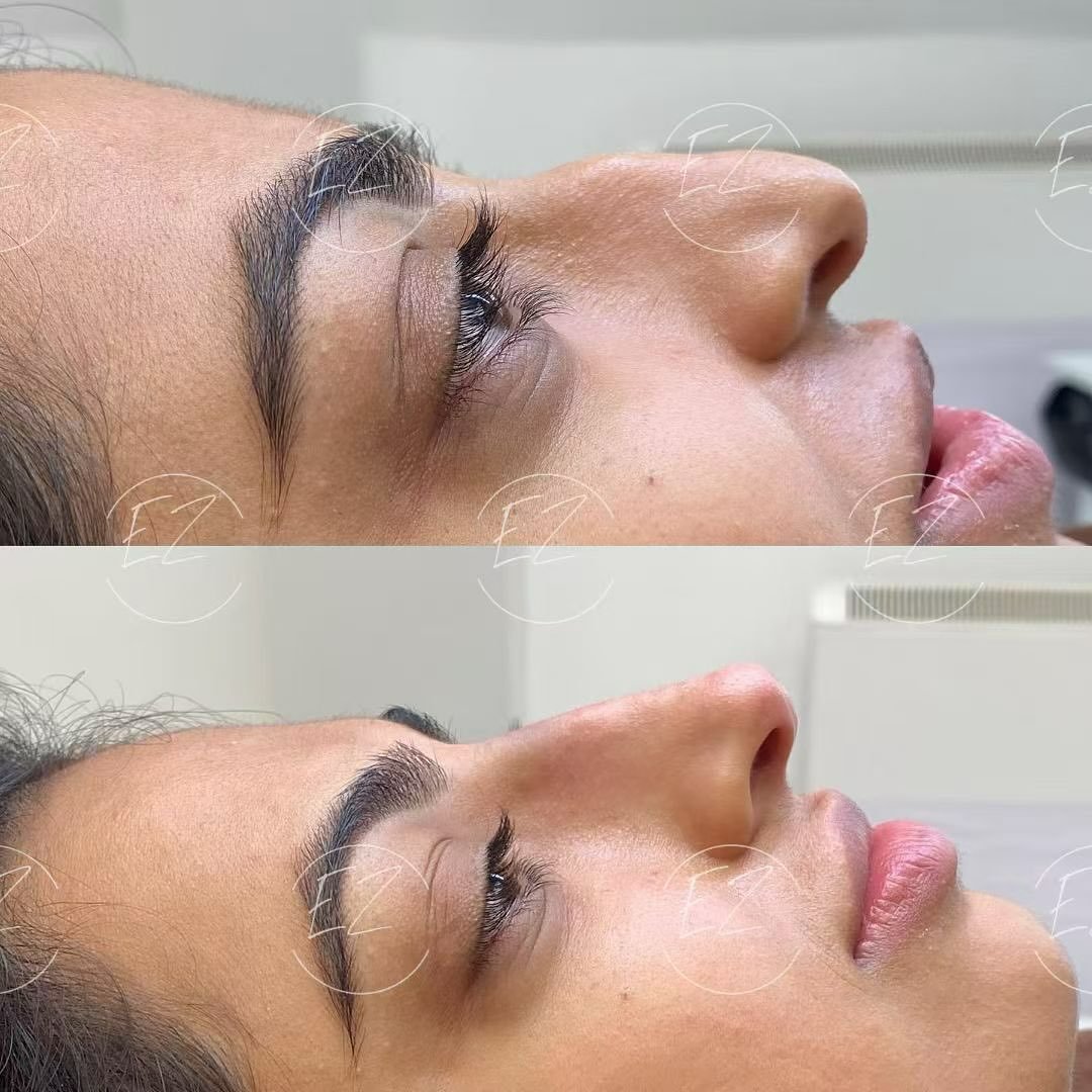 ✨ Case Highlight ✨
Natural lift, elegant refinement 💫

Our latest transformation: softly sculpted natural &ldquo;mini-upturned&rdquo; nose + seamless hump correction. Balanced from every angle, subtle yet stunning.

💎 Minimal, refined, and tailored