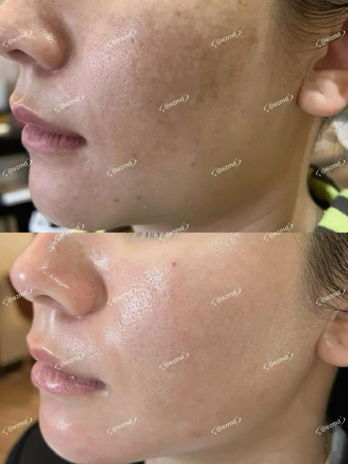 ✨ Star-Tech Glow ✨ Introducing @NOUVADerm Radiance Laser 🌻
Harnessing cutting-edge precision laser energy, it creates thousands of micro-treatment zones to awaken your skin&rsquo;s natural repair process and boost collagen renewal.

💎 In just 10 da