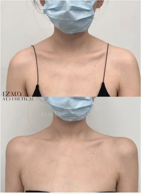 Trapezius Contouring 