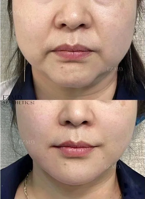 Lower Facial Balance