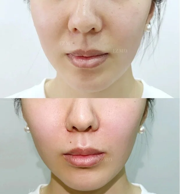 Lower Facial Balance