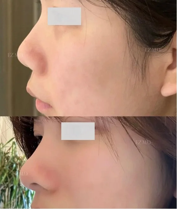 Non-Surgical Rhinoplasty