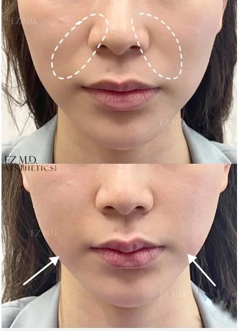 Lower Facial Balance
