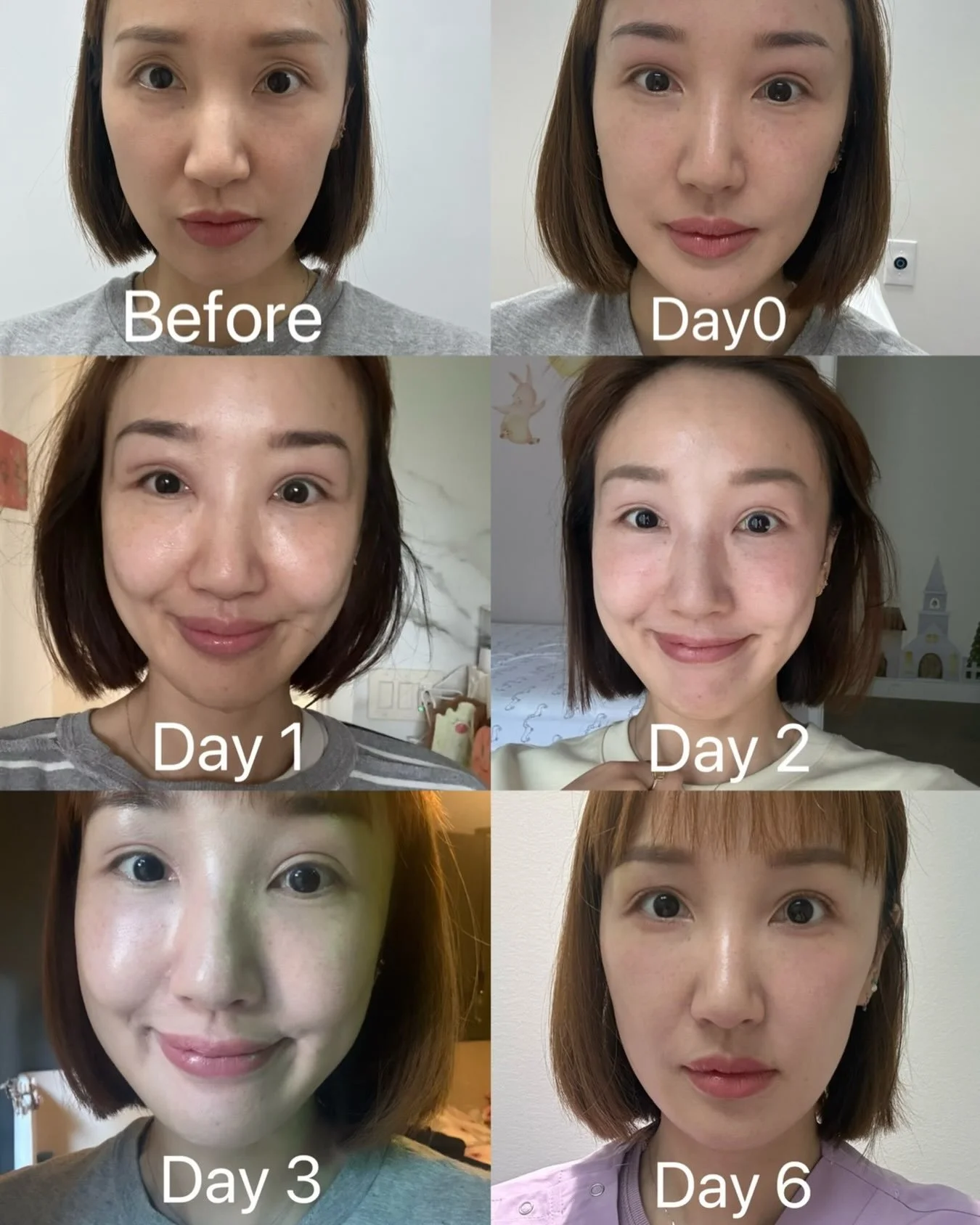 ✨ Brighten your eyes. Refresh your look. Naturally.

Hollow under-eyes can make you look tired, even when you&rsquo;re well-rested. PRF (Platelet-Rich Fibrin) uses your body&rsquo;s own natural growth factors to restore volume, improve skin quality, 