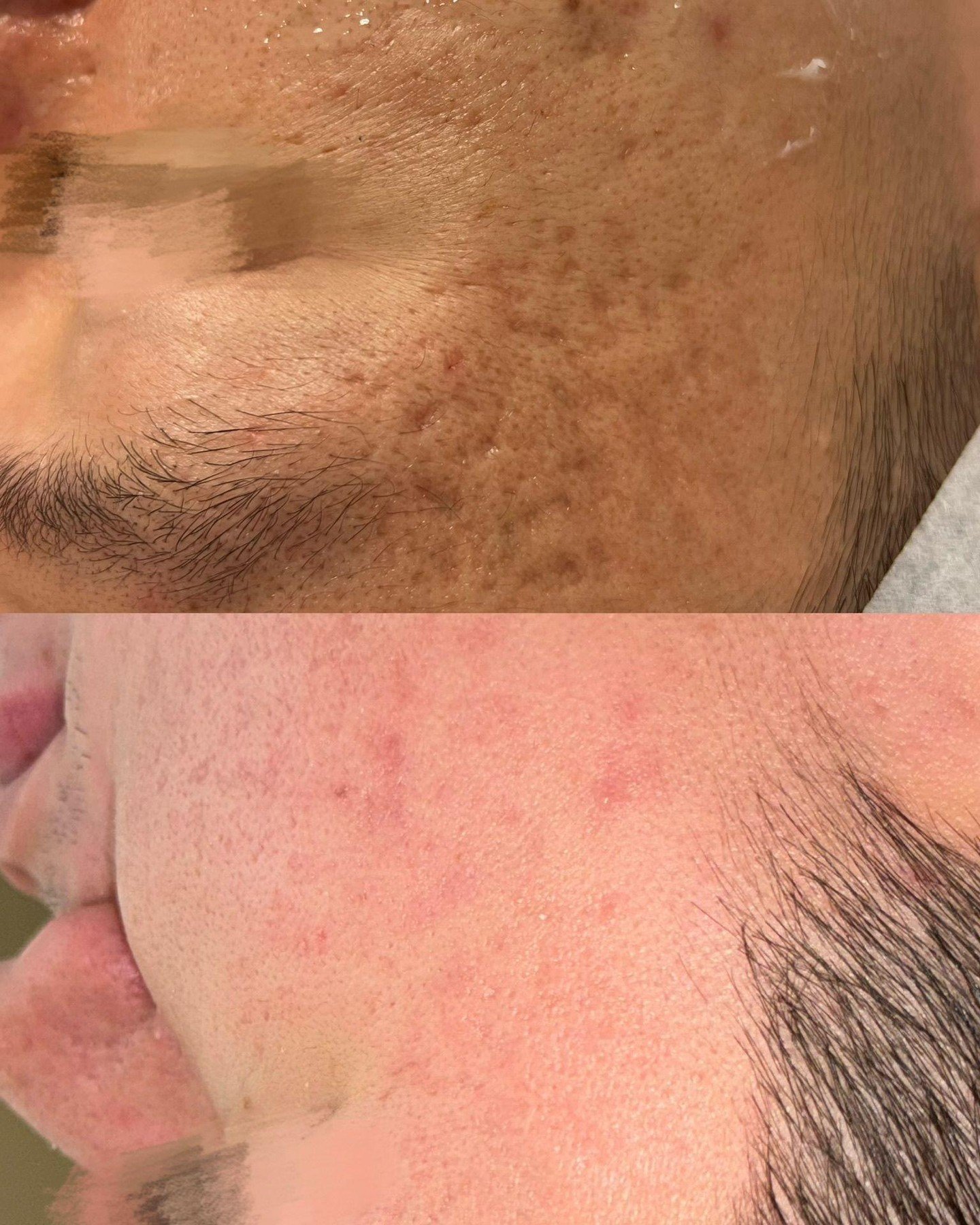 Real stories. Real change. Real confidence returns.

He told us, 'Now I finally see myself.' His skin is smoother, scars fading, and her confidence shines. PRP microneedling with our experts brought her transformation to life.

You deserve to feel th