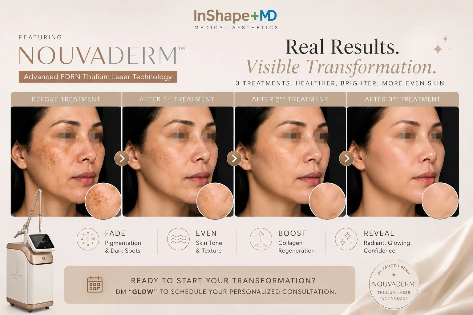 One treatment is impressive. Three treatments tell the real story. ✨
Real results speak louder than promises.✨✨

Every treatment is a step toward healthier, brighter skin.

With NOUVADerm&trade; 1927nm Thulium Laser, pigmentation gradually fades whil