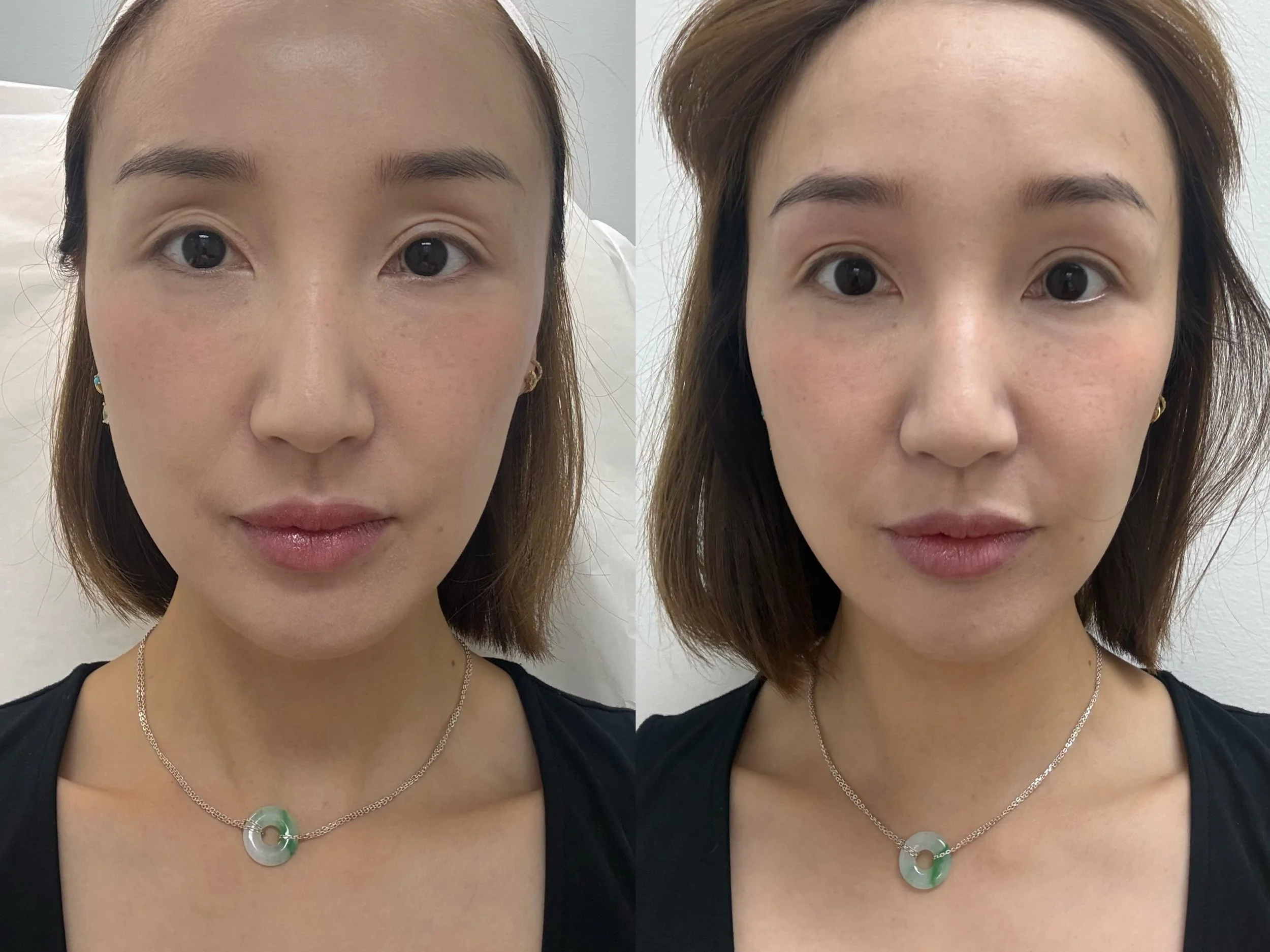 Upper Eyelid Hollow Correction ✨

Hollow upper eyelids can make the eyes look tired, sunken, or more aged &mdash; even when you&rsquo;re well rested.

With carefully placed upper eyelid filler, lost volume can be gently restored to soften the hollow 