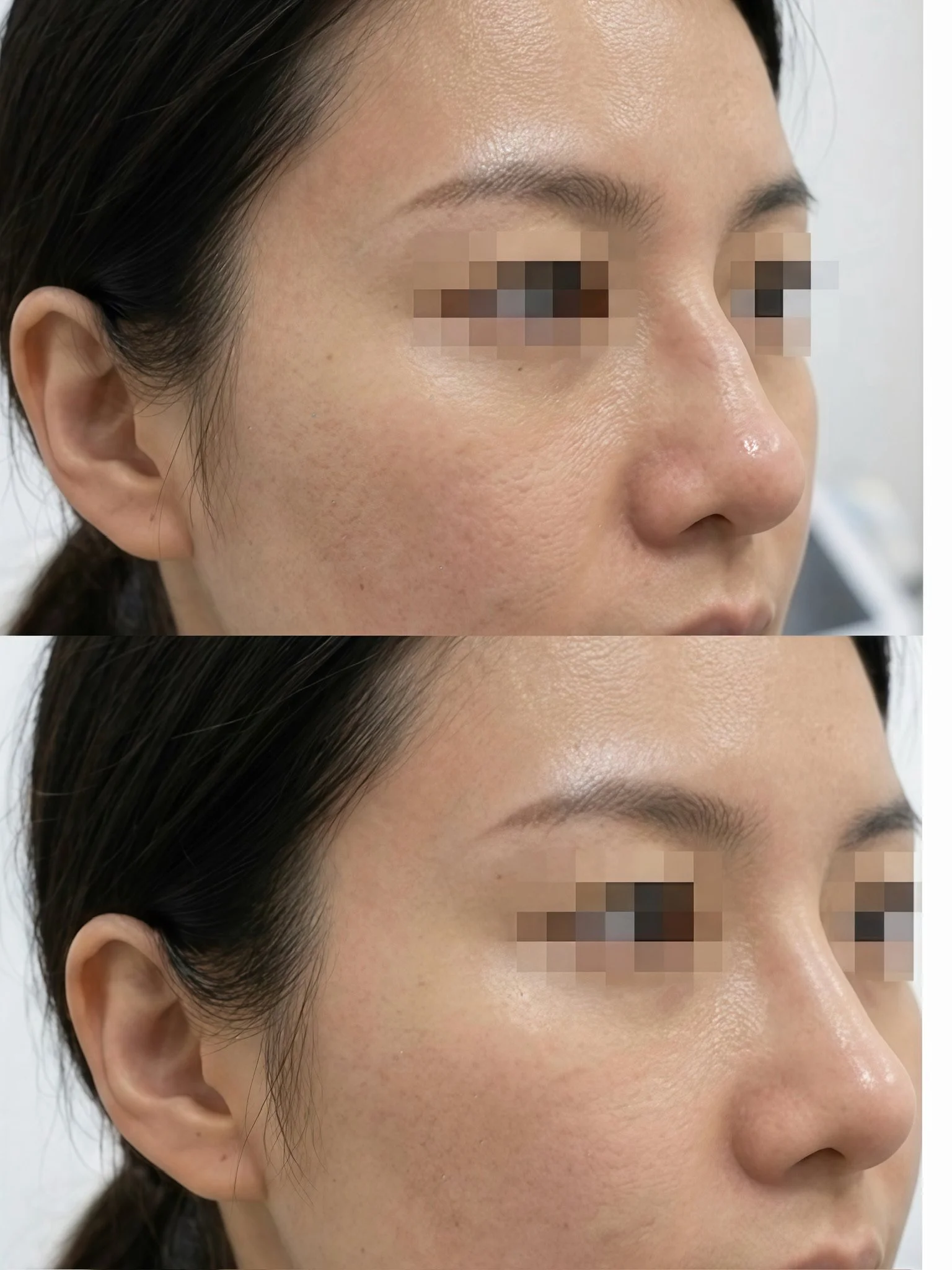 Non-Surgical Rhinoplasty