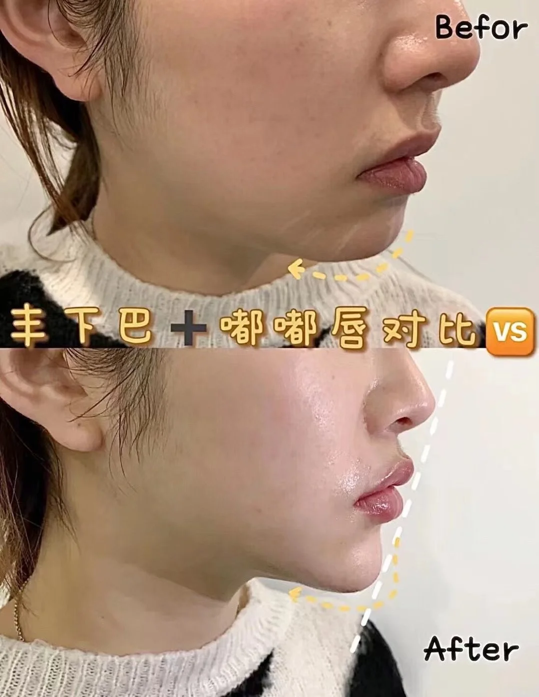 Lower Facial Balance