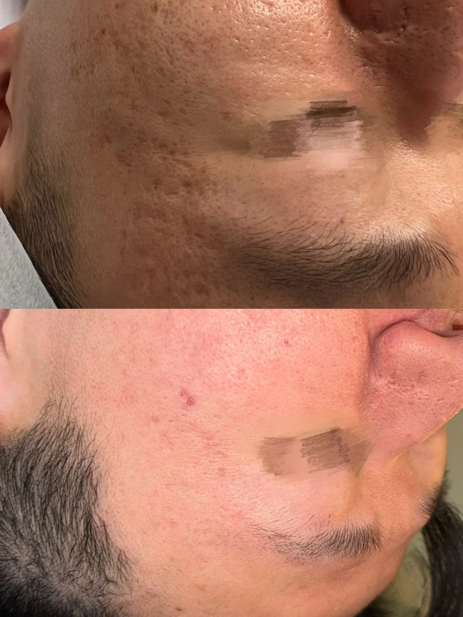 Acne Scar Treatment