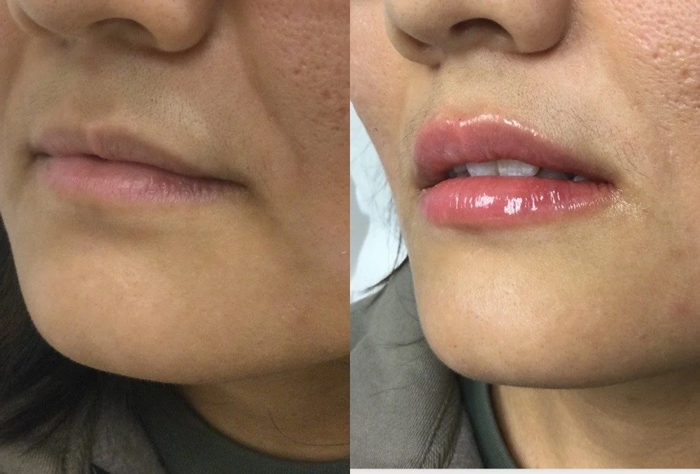 Lip Hydration