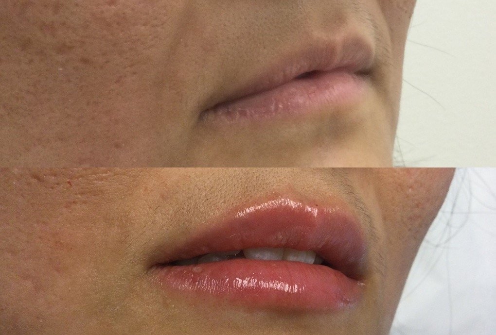 Lip Hydration