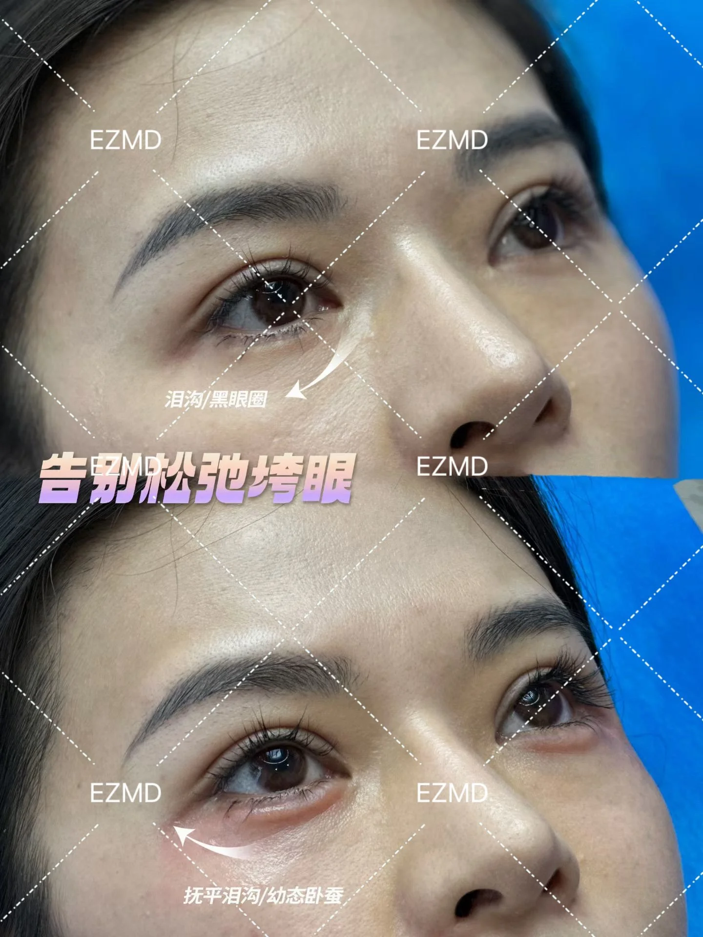 Tear Trough & Tear Bag Refinement
