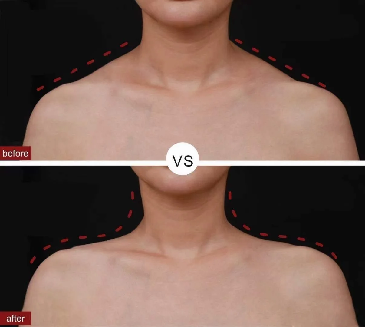 Trapezius Contouring 