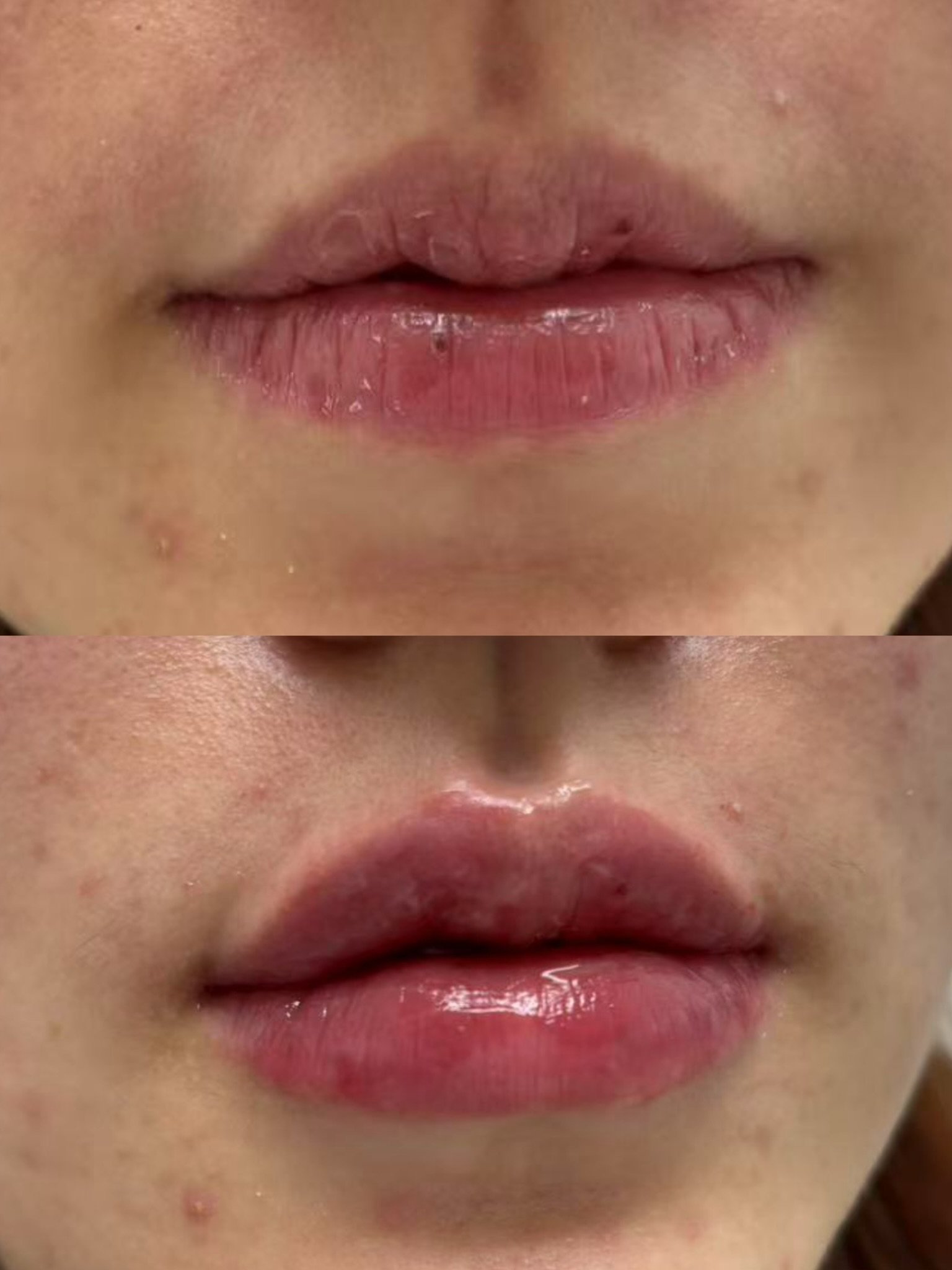 Lip Filler