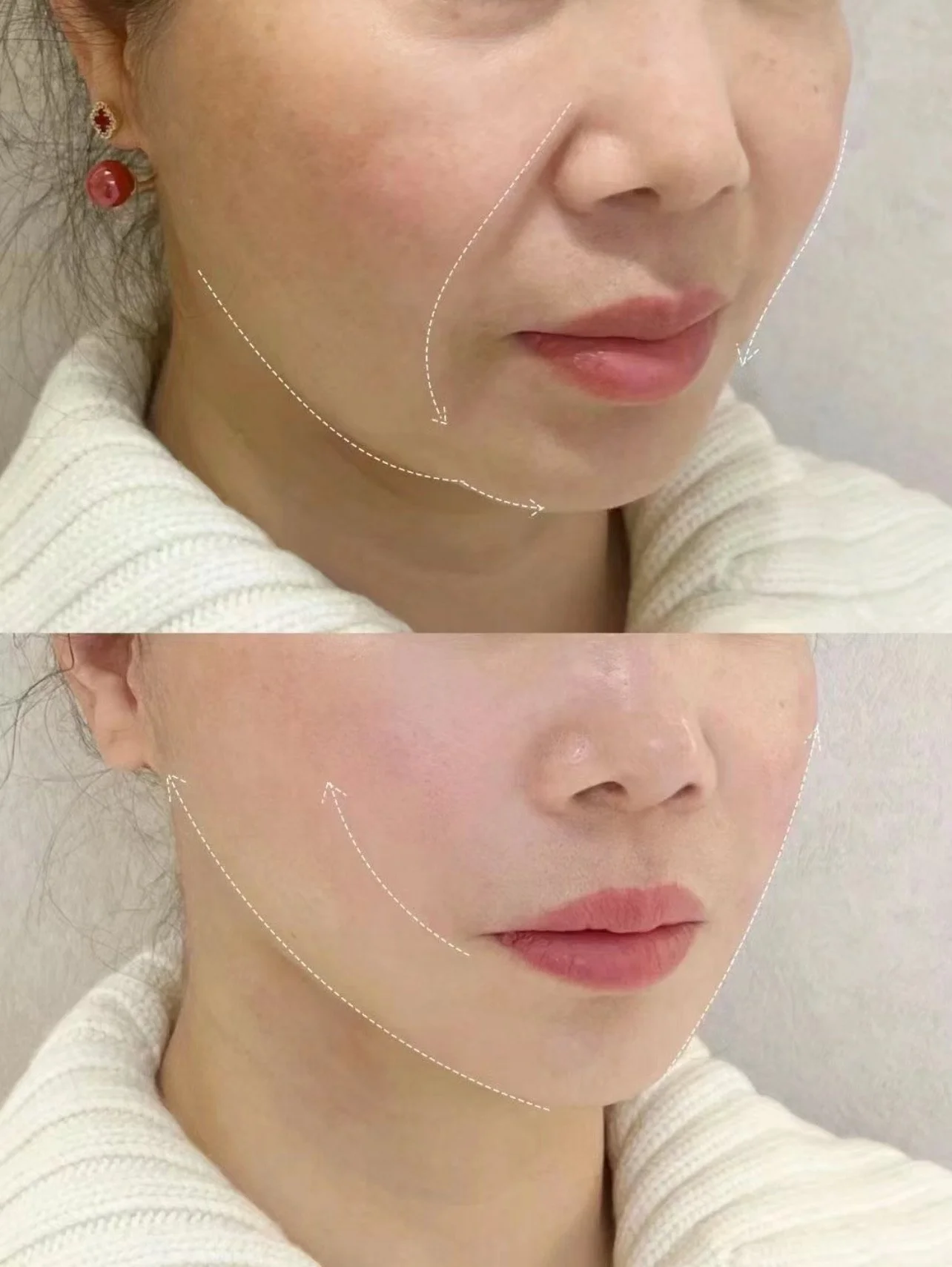 Lower Facial Balance