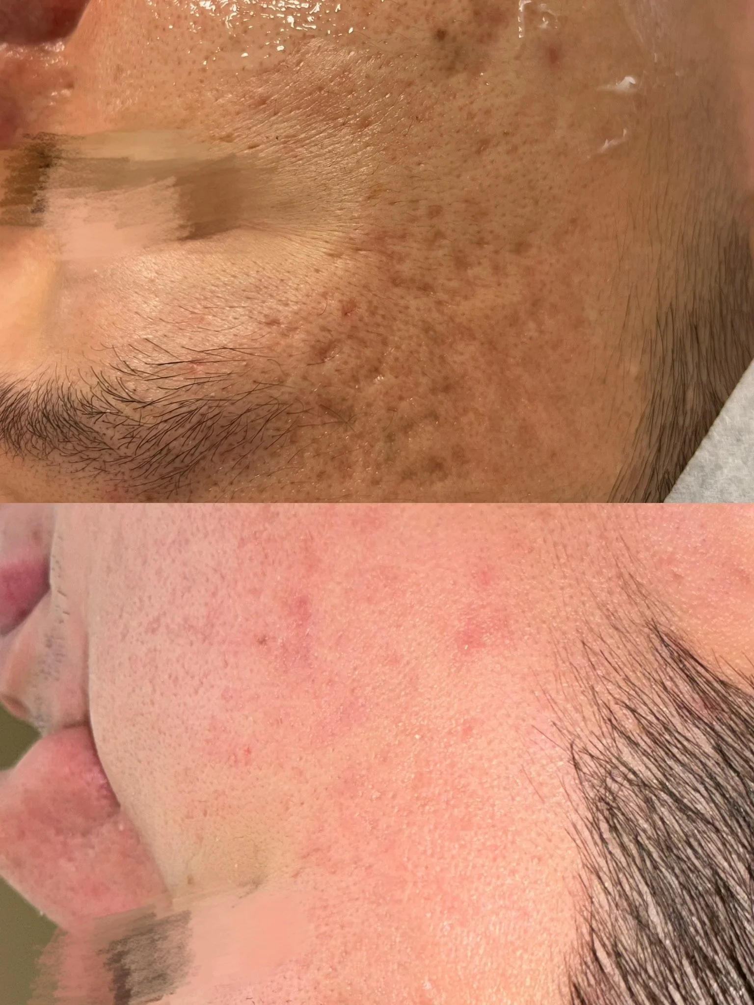 Acne Scar Treatment