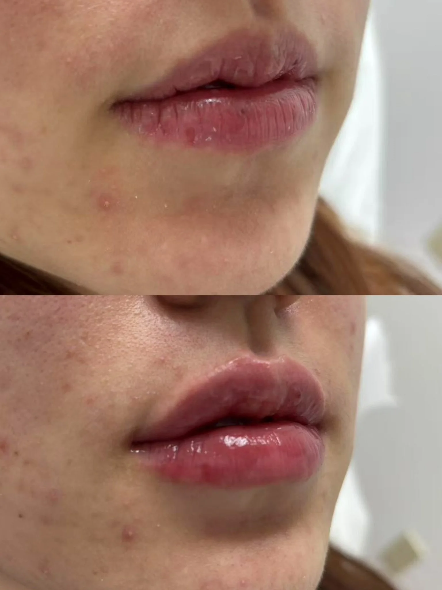 Lip Filler