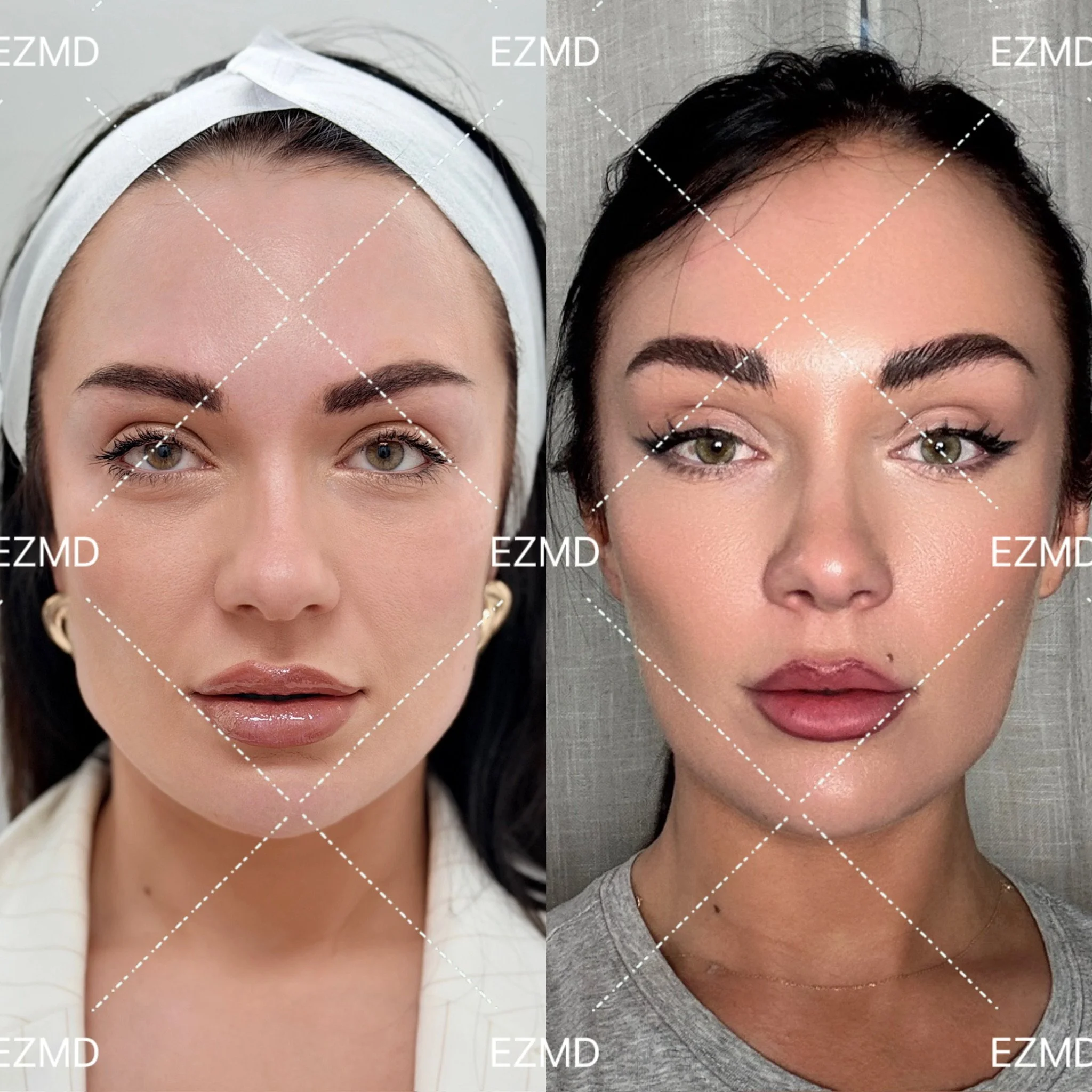 Facial Harmony & Balance 