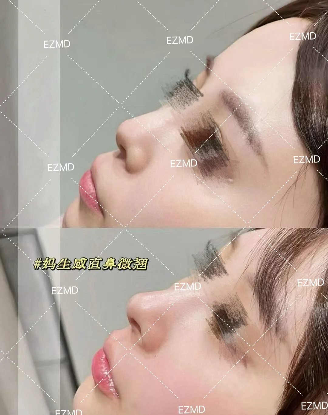 Non-Surgical Rhinoplasty