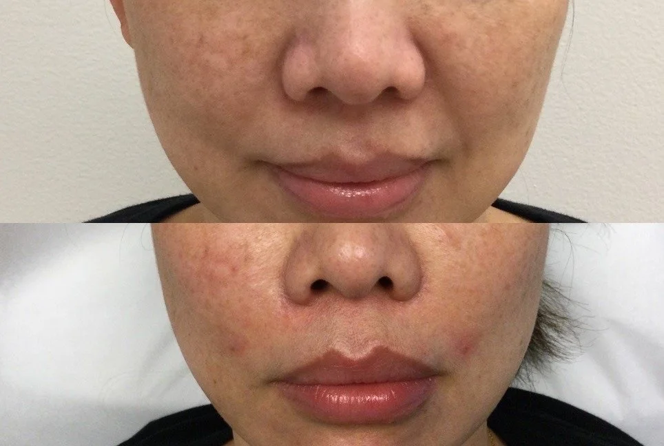 Lower Facial Balance