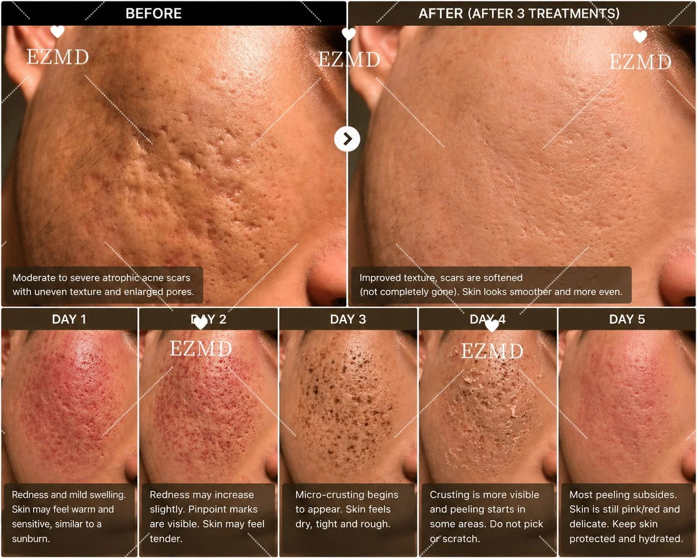 Acne Scar Treatment