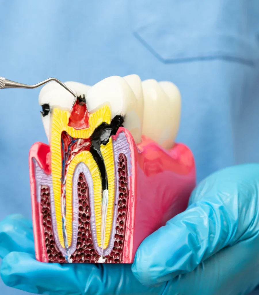 Restorative Dentistry in Atlanta, GA — Tiny Roots Pediatric Dental Studio
