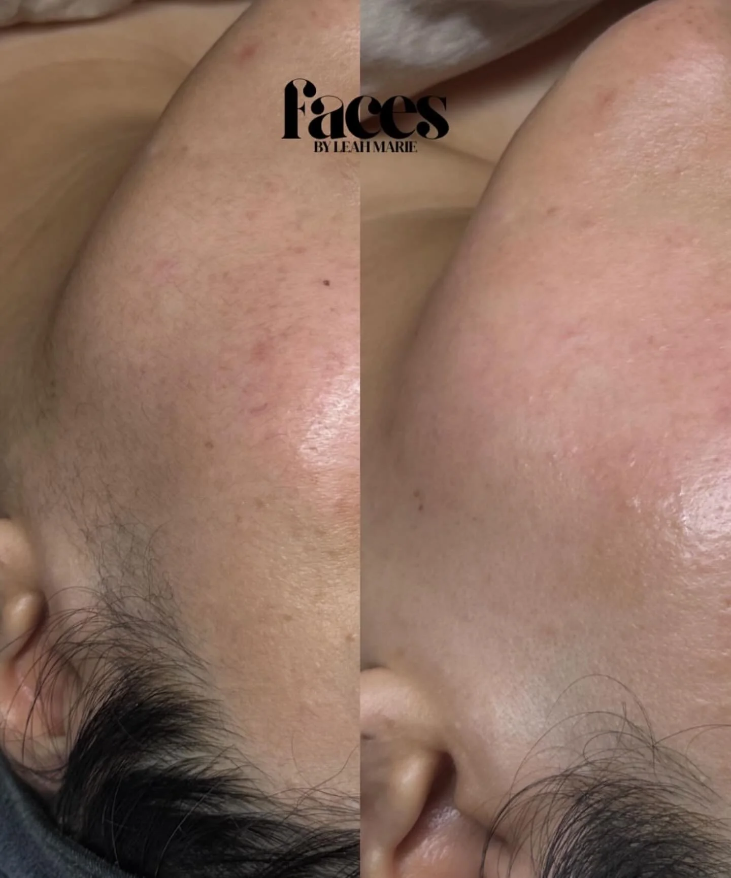 the ⚡️𝙥𝙤𝙬𝙚𝙧⚡️ of the dermaplane + peel 𝙙𝙪𝙤