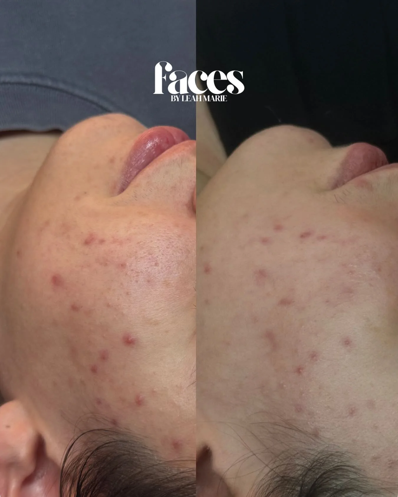 before &amp; after of this beautiful babes first 𝙢𝙞𝙘𝙧𝙤𝙣𝙚𝙚𝙙𝙡𝙞𝙣𝙜 appointment 🪄 (photos taken 1 month apart)

👀
inflammation has drastically decreased 
pores are visibly smaller
skin is more hydrated 

💁🏻&zwj;♀️
client has experienced l