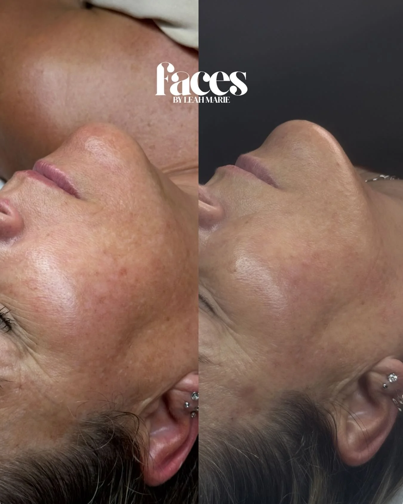 let&rsquo;s talk about this 𝘣𝘦𝘧𝘰𝘳𝘦 &amp; ❤️&zwj;🔥 𝙖𝙛𝙩𝙚𝙧 ❤️&zwj;🔥

this beauty started seeing me in september 2024. her main concerns were sun damage, aging, rooted lines &amp; overall dullness

we started by worked through the most impor