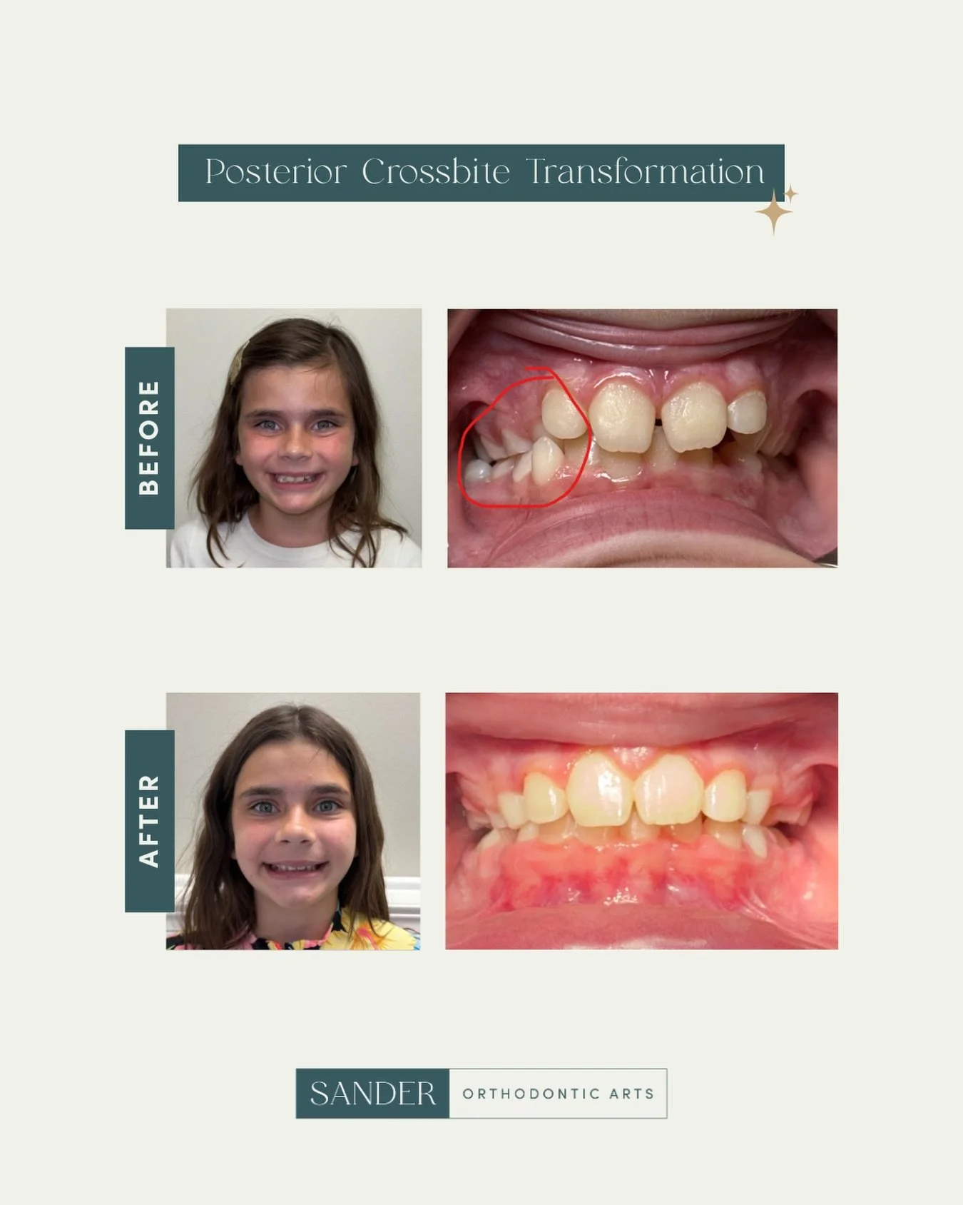 When Avery came to see us, she had a posterior crossbite. Her upper jaw was narrower than her lower jaw, which meant her back teeth weren&rsquo;t lining up the way they should on her right side. 🦷

We started with Phase 1 treatment: a rapid palatal 