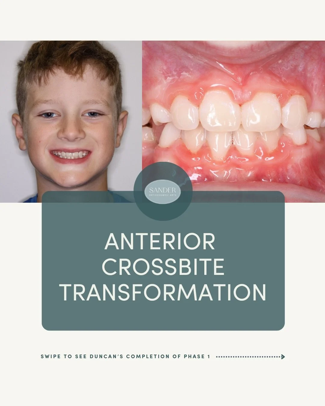 What a difference early orthodontic treatment can make! 

Duncan had an anterior crossbite, meaning his upper front teeth were sitting behind his lower front teeth instead of in front. 

With an expander, an orthopedic appliance, and phase 1 braces, 
