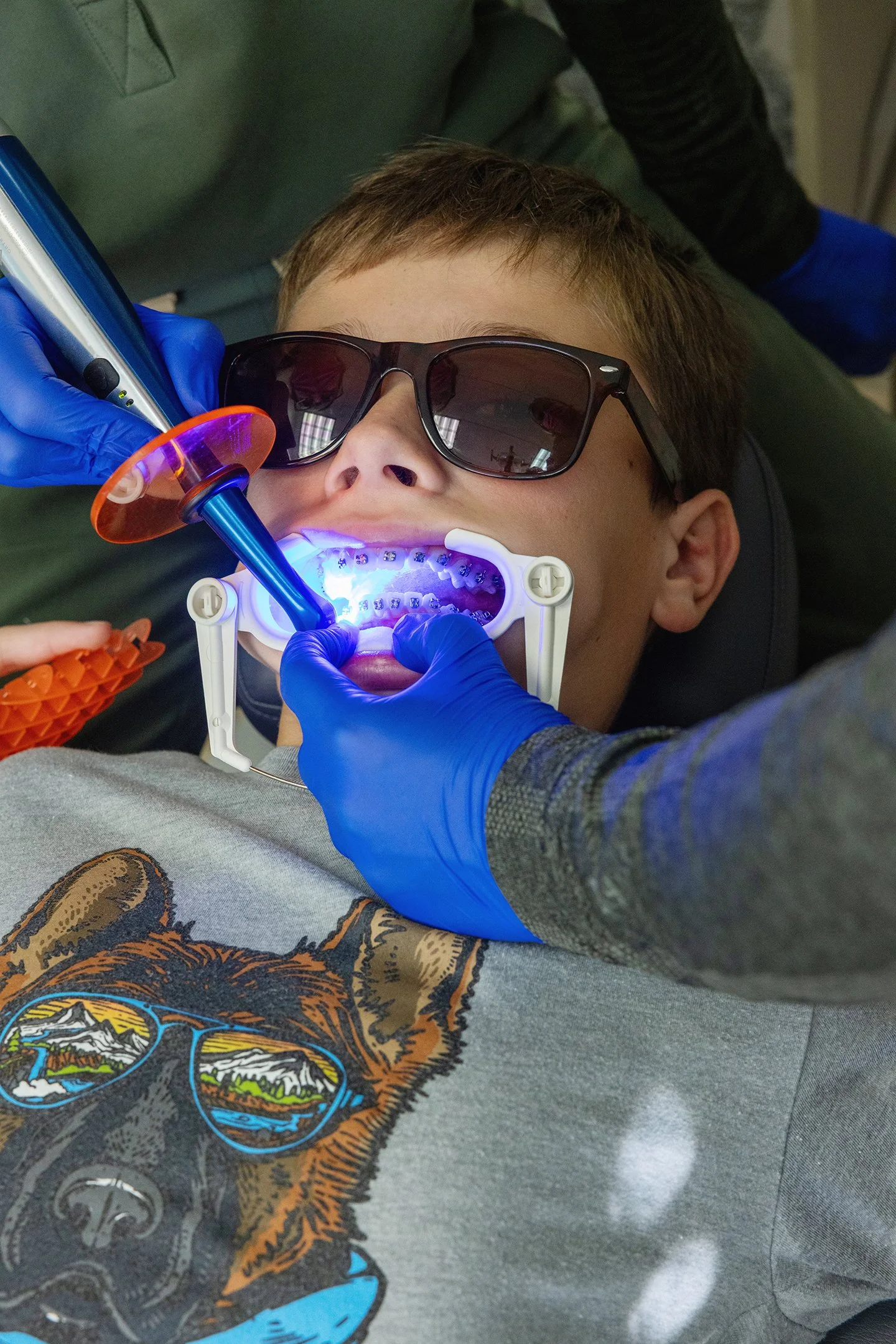 Example of Phase 1 orthodontic treatment used to guide jaw growth and create space for permanent teeth