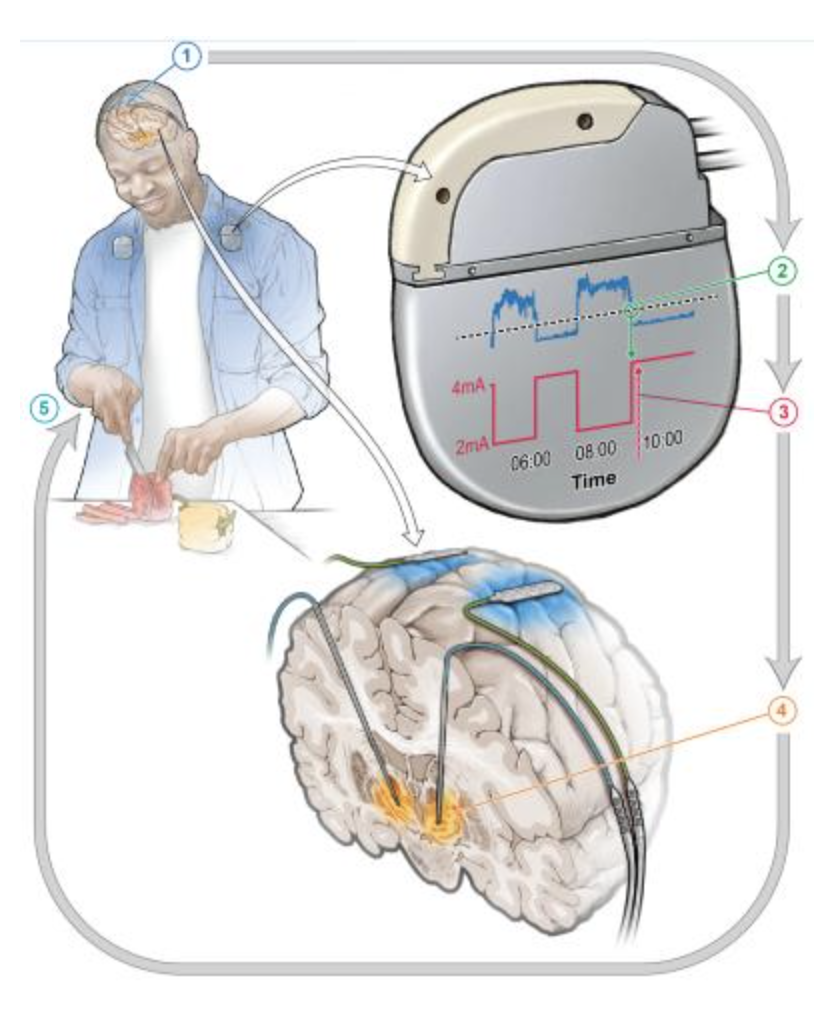 The Promising Future of Parkinson’s Treatment