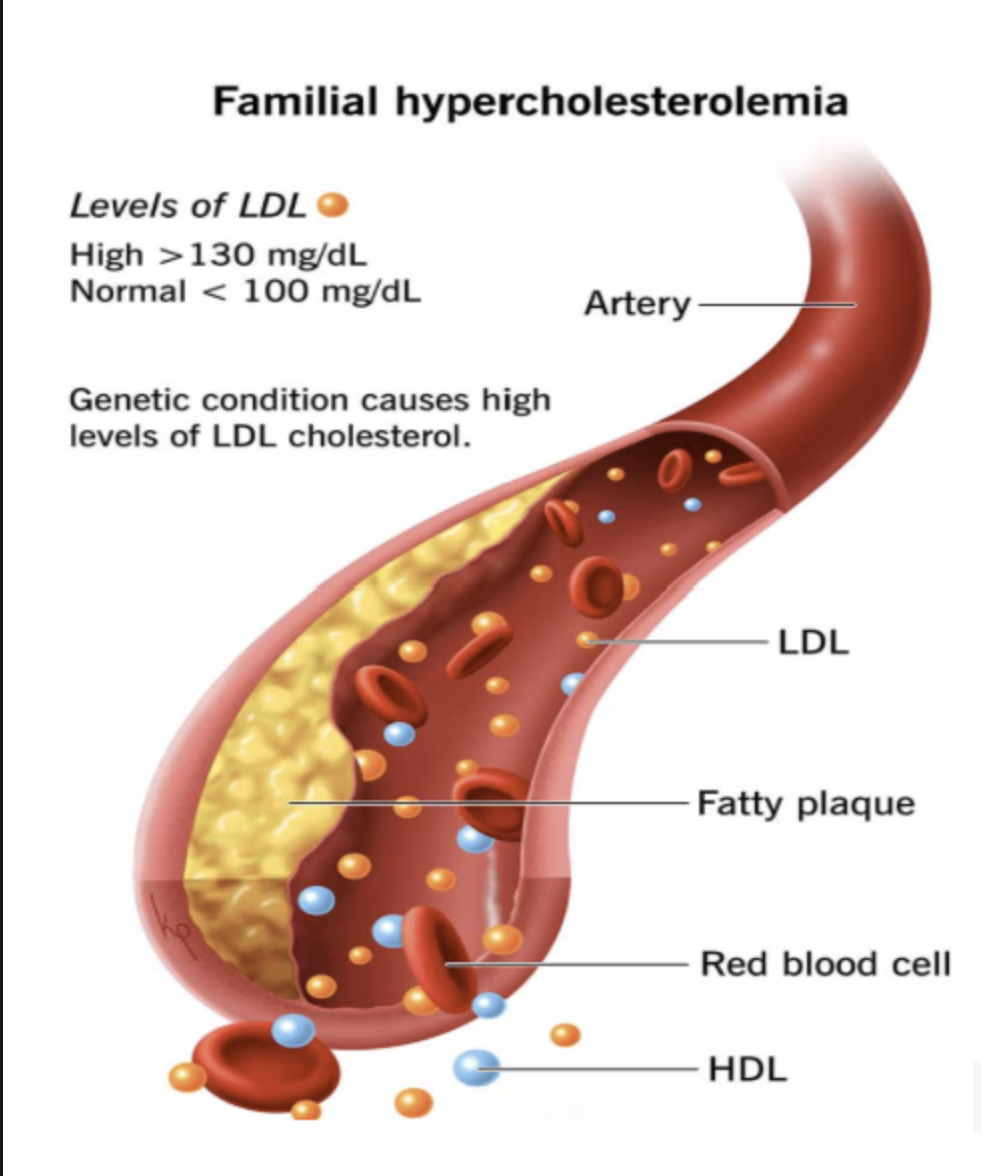 Familial Hypercholesterolemia