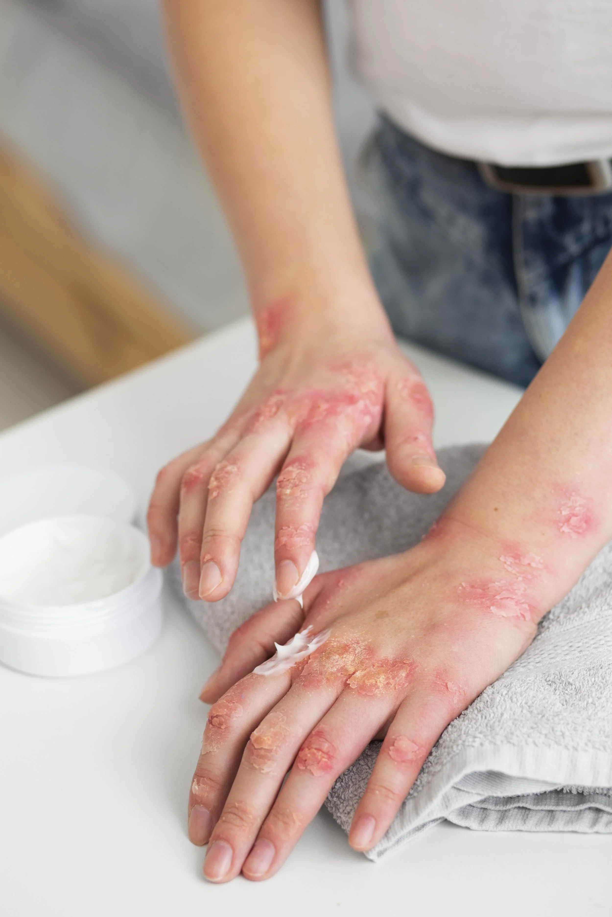 hands-patient-suffering-from-psoriasis (1).jpg