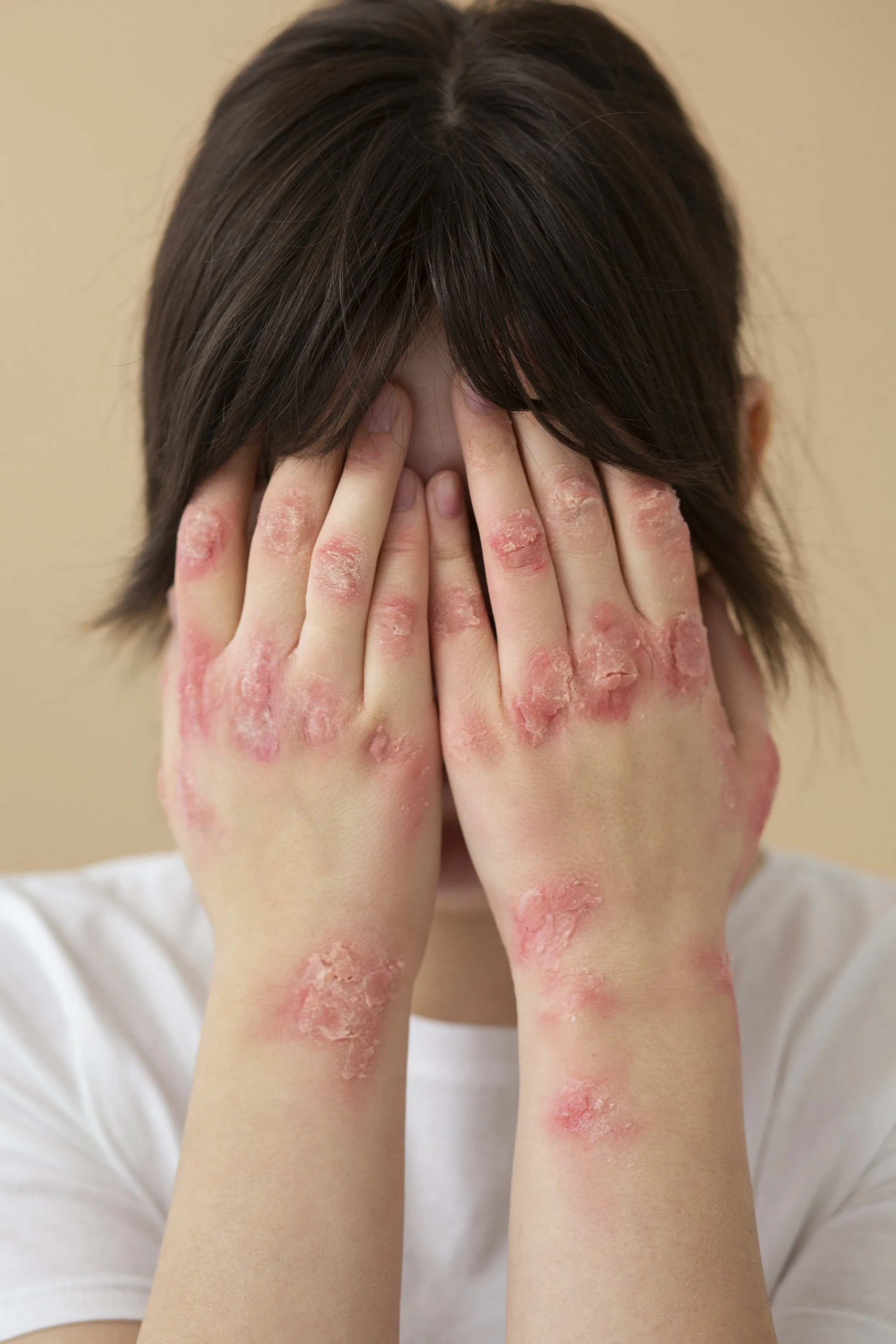 hands-patient-suffering-from-psoriasis.jpg