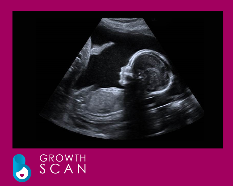 Baby Scan Leeds - Scans From £49 Only