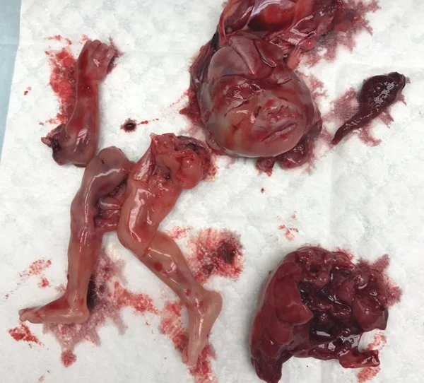 2nd Trimester (Surgical Abortion)