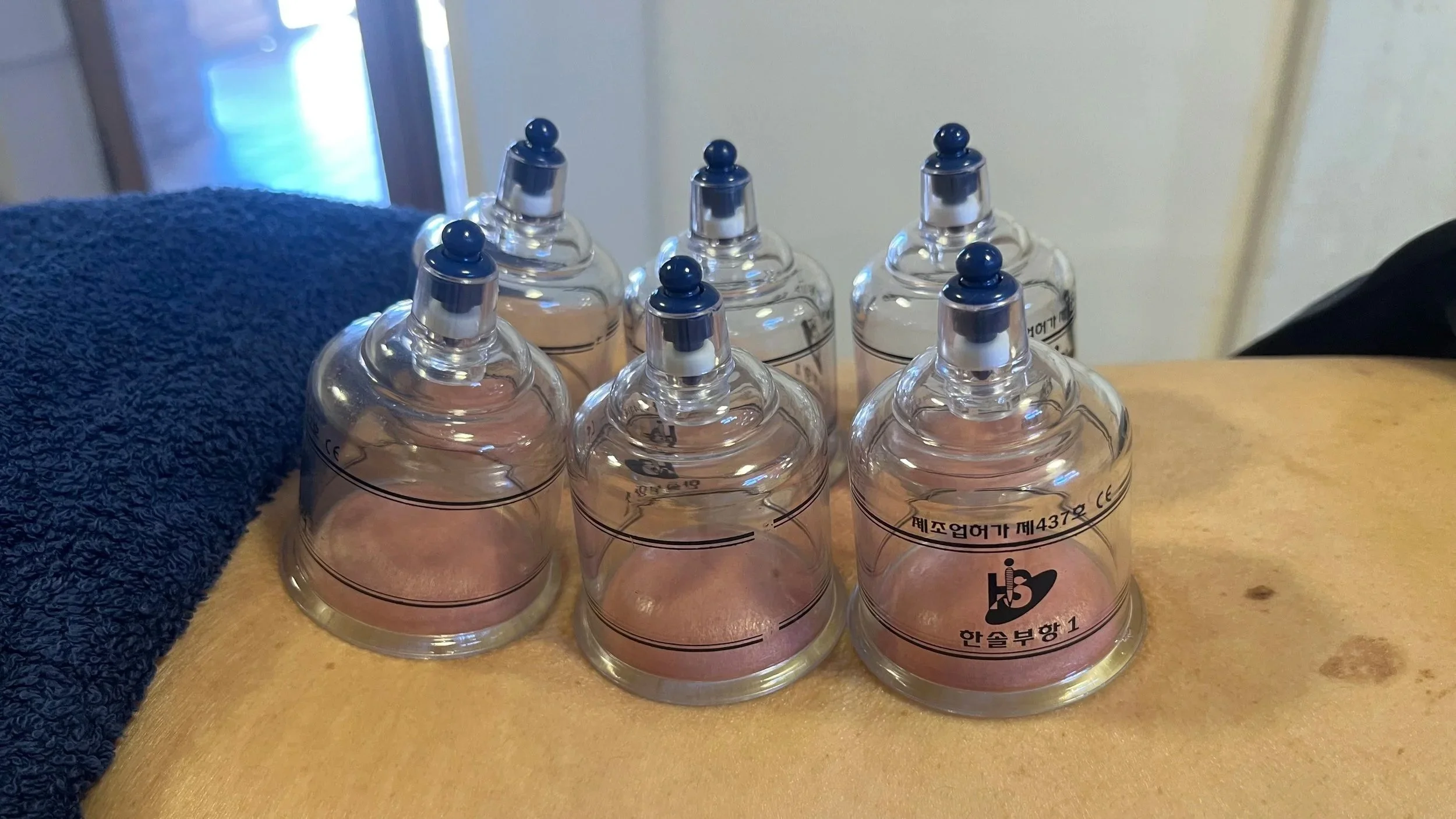 Dry cupping being placed on someone’s back who is lying face down. The area of muscle overlying the lumbar spine has been pulled up into the cup to improve blood flow.