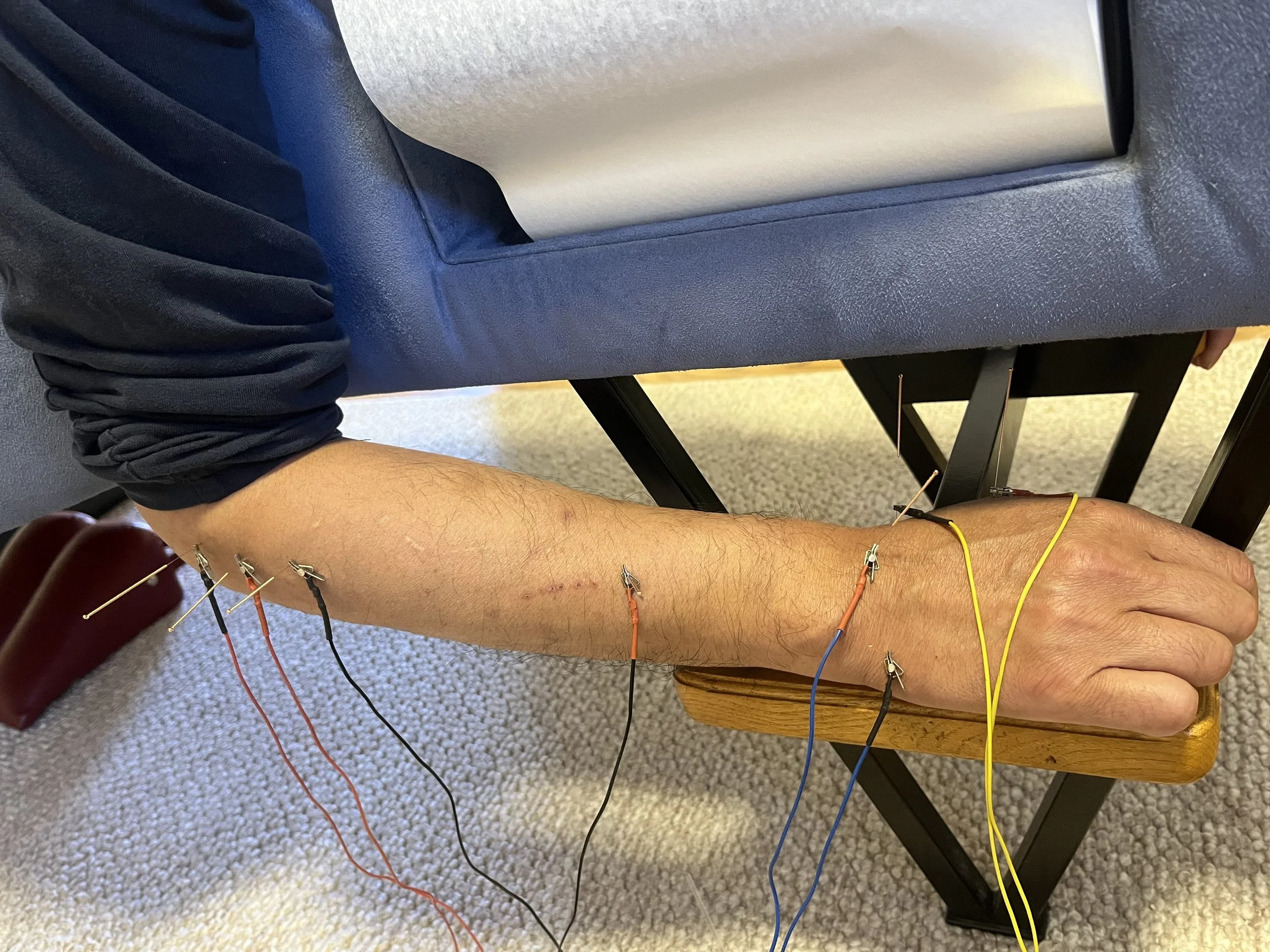 A person's arm with acupuncture needles inserted along it, lying face down on a comfortable chiropractic table.