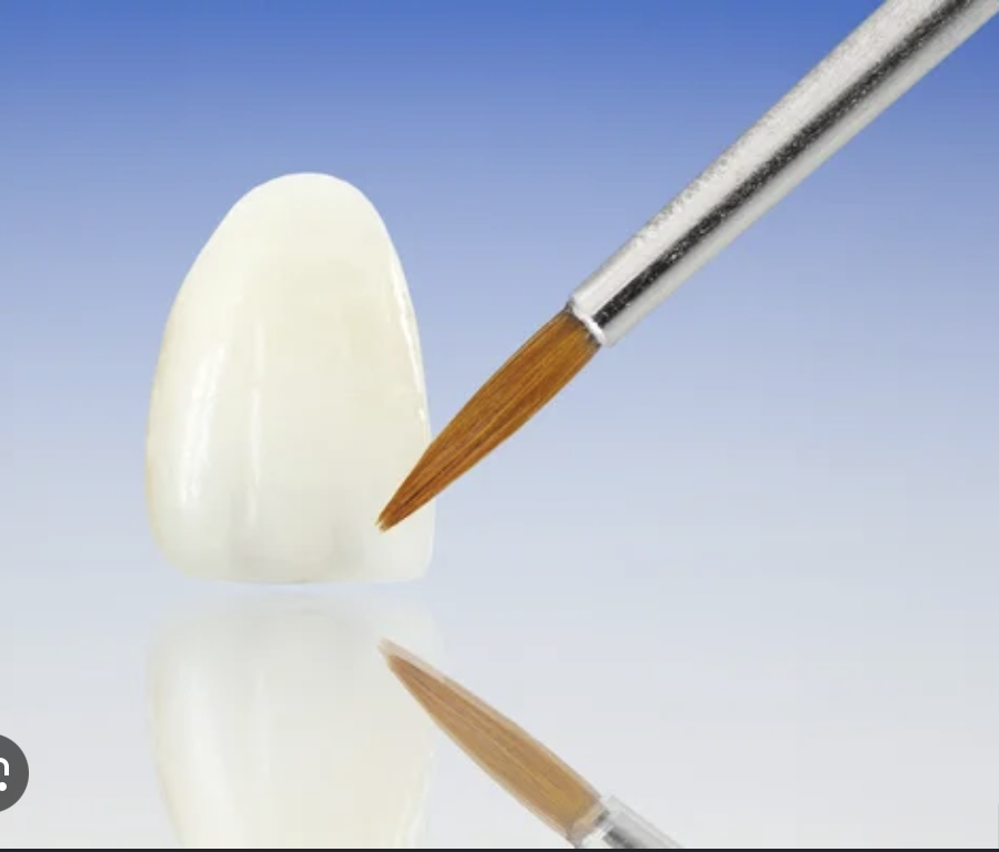 Veneers vs. Cosmetic Bonding