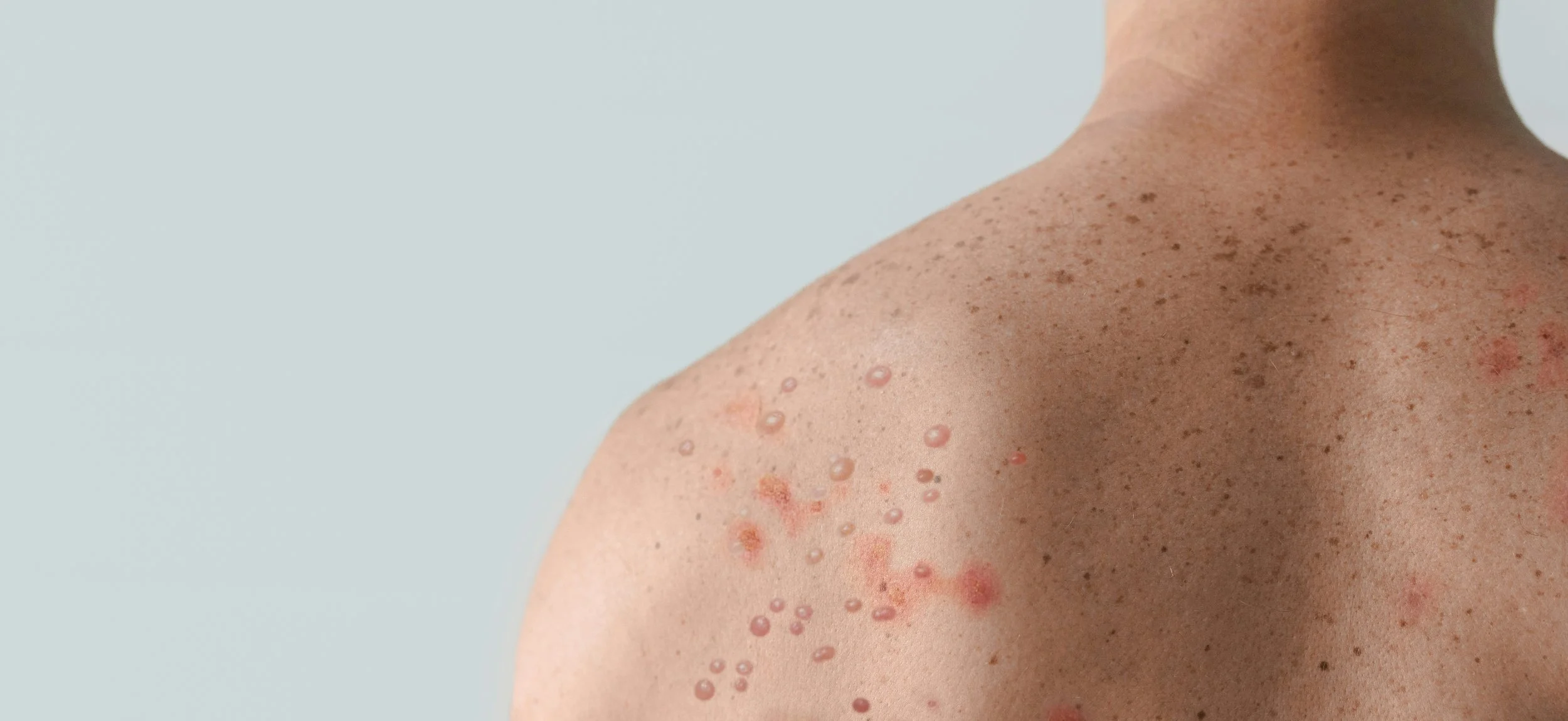 FAQs About Measles