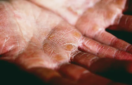 Understanding Dermatologic Concerns Among Persons Experiencing Homelessness: A Scoping Review and Discussion for Improved Delivery of Care