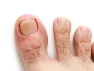 What Is the Easiest Way to Remove an Ingrown Toenail?