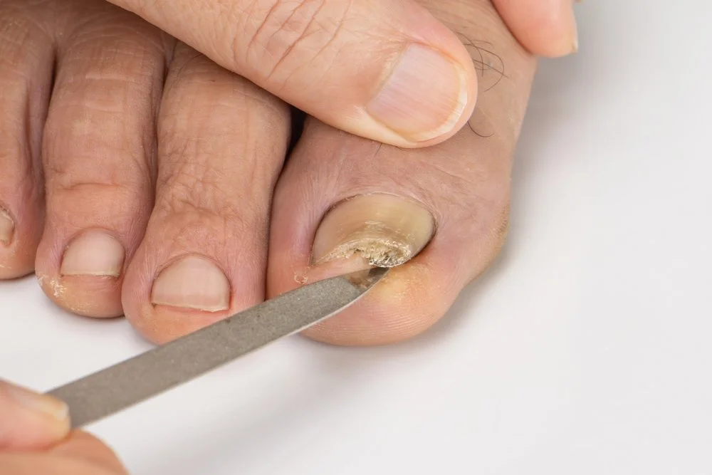 What Causes Ingrown Toenails?