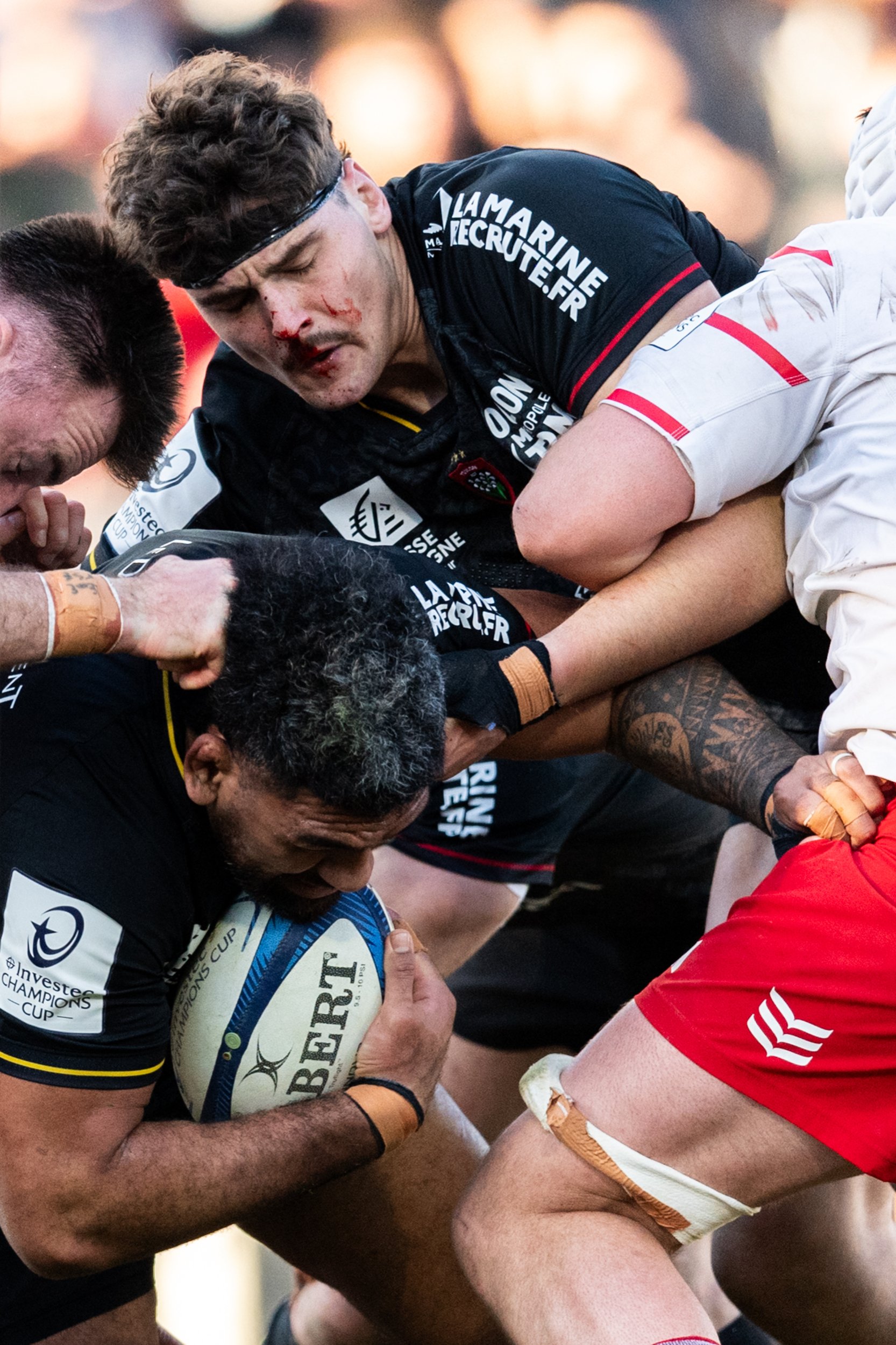 Brian Alainu'uese RCT