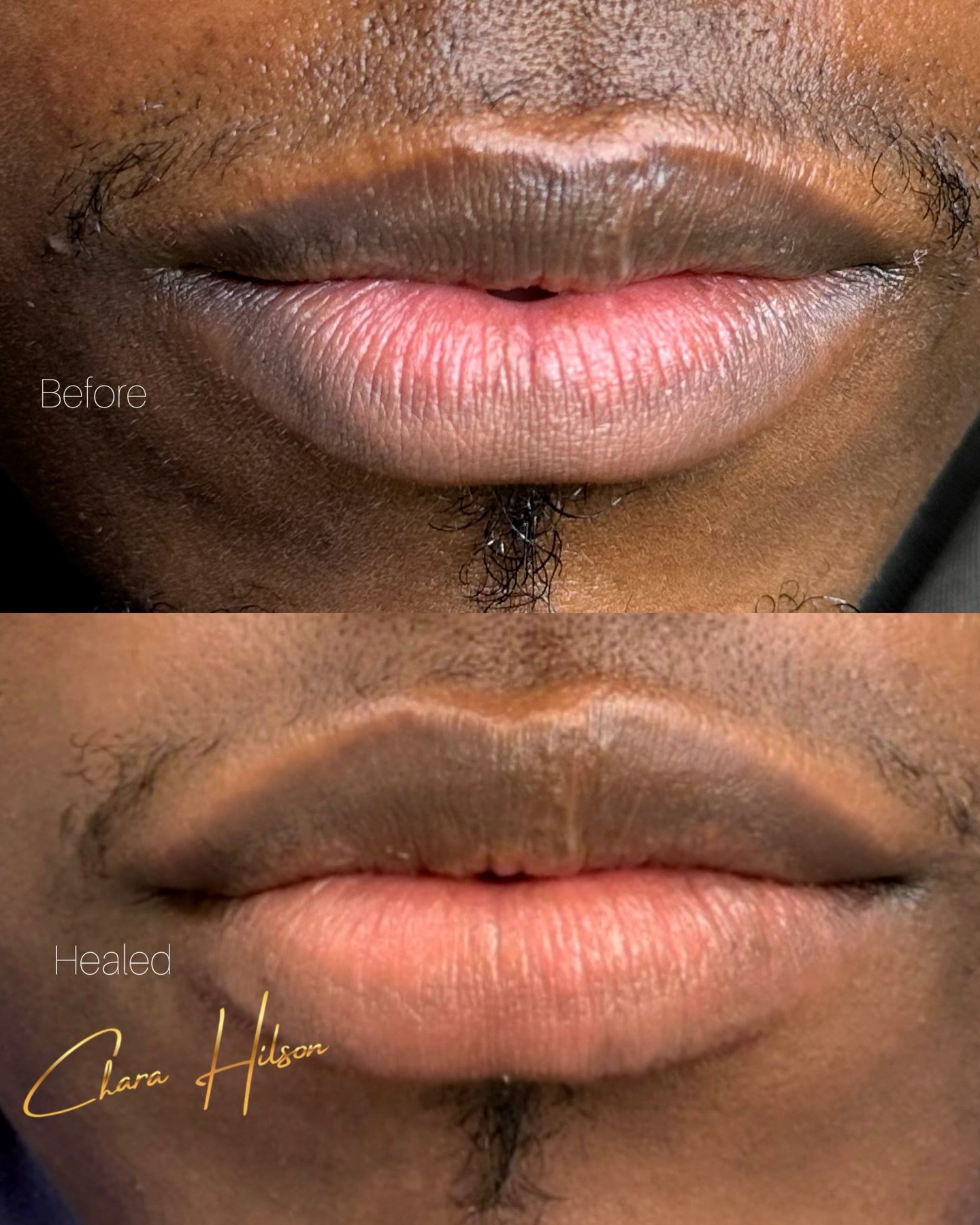 Healed bottom-lip neutralization results 💋
At this stage, softness is expected and intentional.

1st photo: Before &amp; Healed 
2nd photo : Before
Videos: Immediately after first treatment 

Lip neutralization is a layering process, not a one-and-d