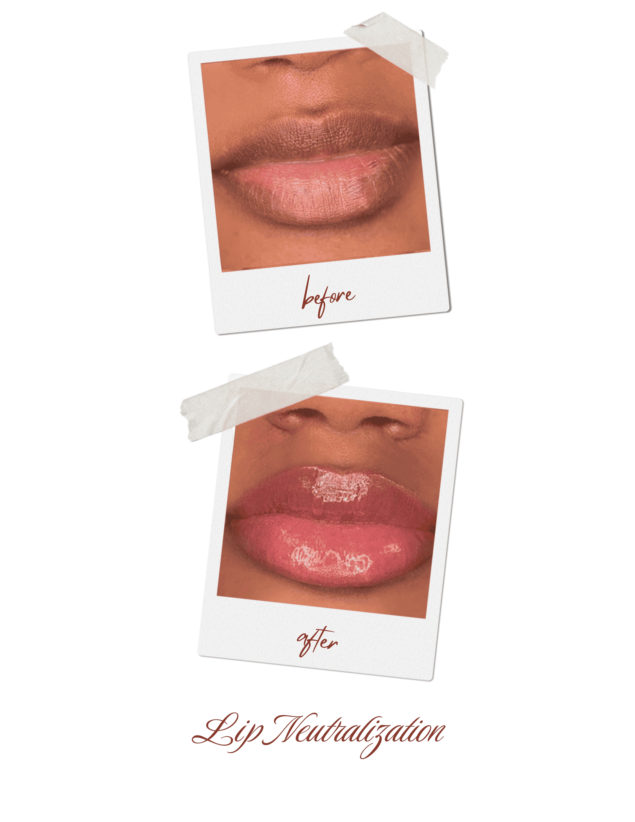 LIP NEUTRALIZATION